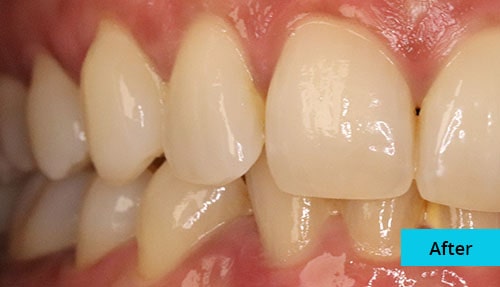 Laser Gum bleaching case-3 after image - Bayswater Dental Clinic