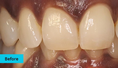 Laser Gum bleaching case-3 before image - Bayswater Dental Clinic