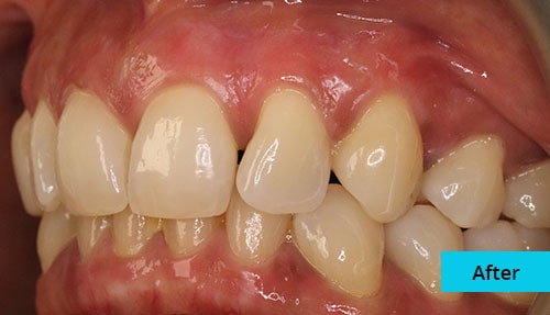 Laser Gum bleaching case-4 after image - Bayswater Dental Clinic