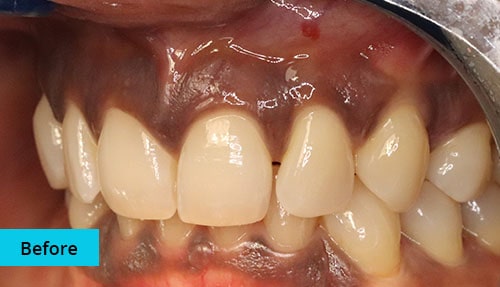 Laser Gum bleaching case-4 before image - Bayswater Dental Clinic