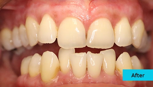 Laser Gum bleaching case-5 after image - Bayswater Dental Clinic