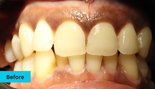 Laser Gum bleaching case-5 before image - Bayswater Dental Clinic