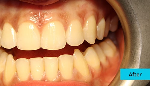 Laser Gum bleaching case-6 after image - Bayswater Dental Clinic