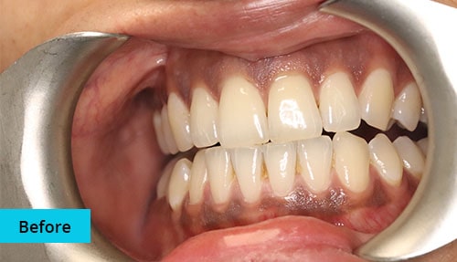 Laser Gum bleaching case-6 before image - Bayswater Dental Clinic