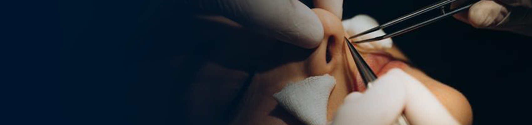 Nasolabial Folds & Marionette Lines Treatment