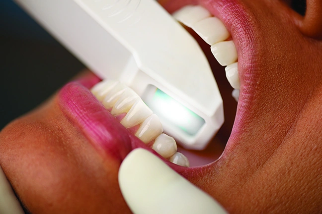 Necessary Appointments before taking Clear aligners in London