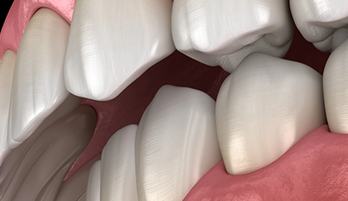 Potential Complications untreated in London