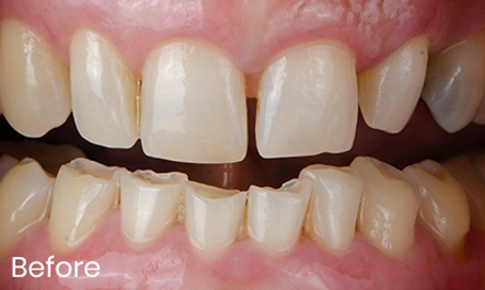 price on Composite Bonding in london