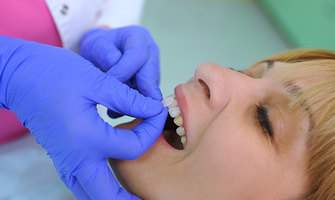 How Long Composite Veneers and Porcelain Veneers Last