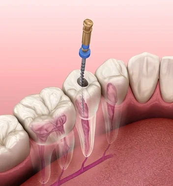Root canal Treatment London - Bayswater Dental Clinic
