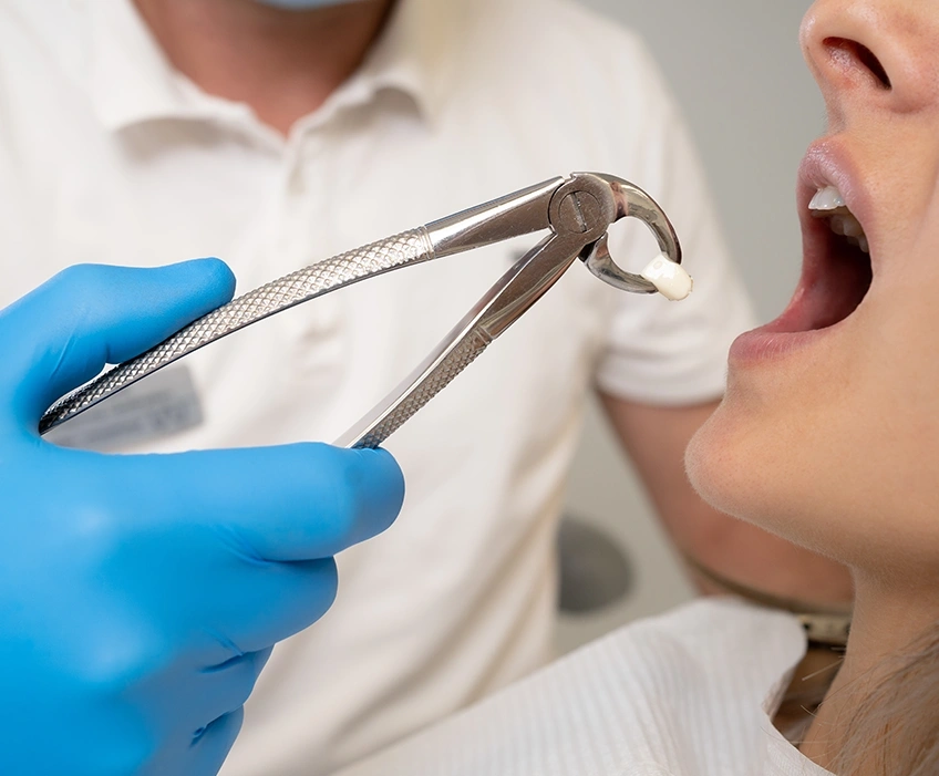 Are there any side effects of wisdom teeth removal? – Bayswater Dental Clinic