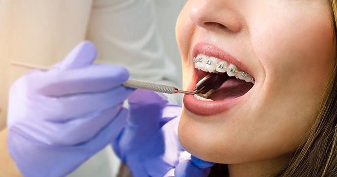 Six Month Smiles by Bayswater Dental Clinic in Paddington, London