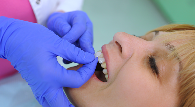 Before composite bonding in dentistry?