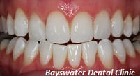 Teeth Whitening treatment after image - Bayswater Dental Clinic