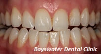 Teeth Whitening treatment before image - Bayswater Dental Clinic