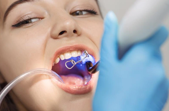 What are the advantages of Dental Bonding?