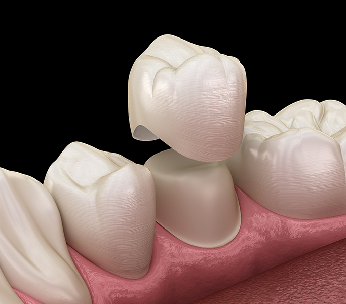 Type of Dental Crowns are Available - Explained by Bayswater Dental Clinic