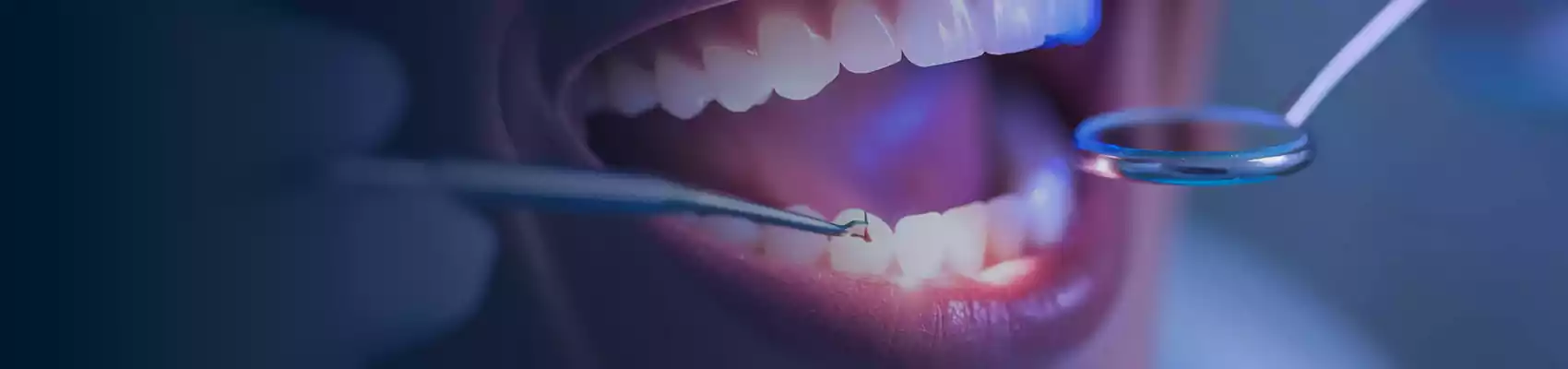 What Are The Disadvantages Of Composite Bonding?