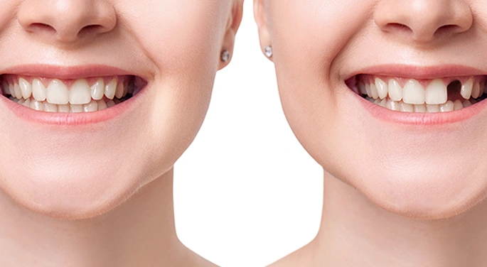 What Are The Symptoms of Gapped Teeth?