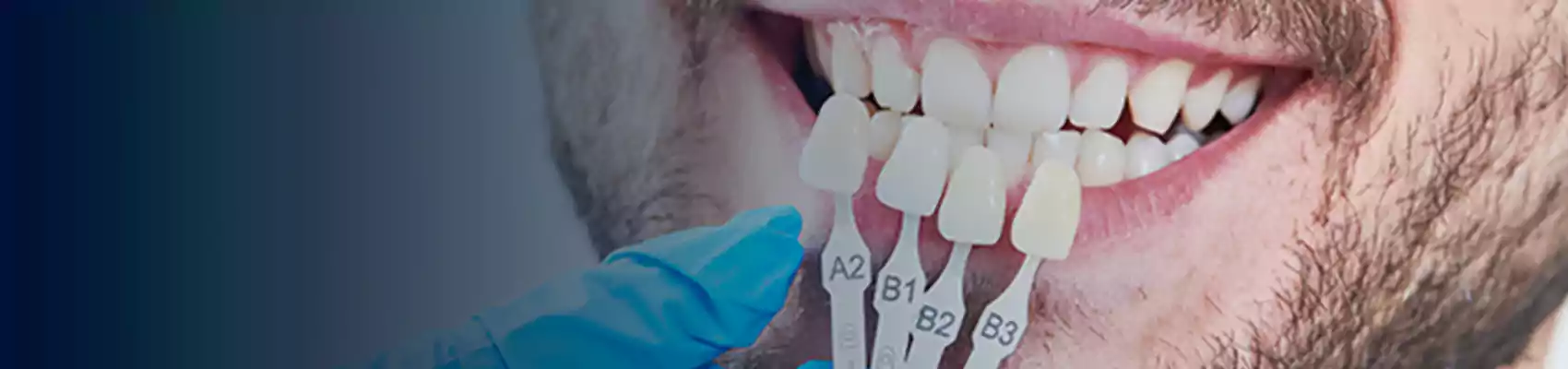 What Is The Cost Of Each Composite Bonding?