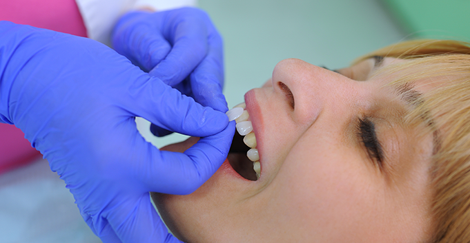 What is the procedure For Getting Dental Veneers