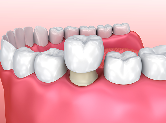 Type of Dental Crowns are Available - Explained by Bayswater Dental Clinic