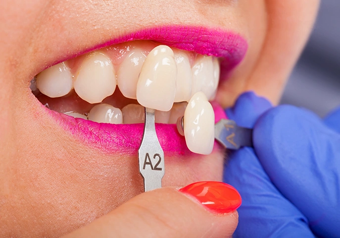 Who can have Composite Veneers?