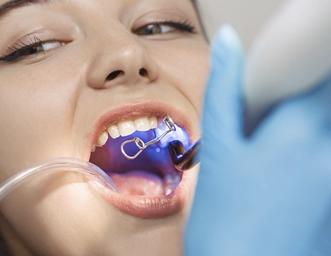 Who Can Have Dental Bonding?