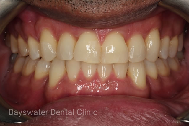 Bayswater Dental Clinic Invisalign After Image