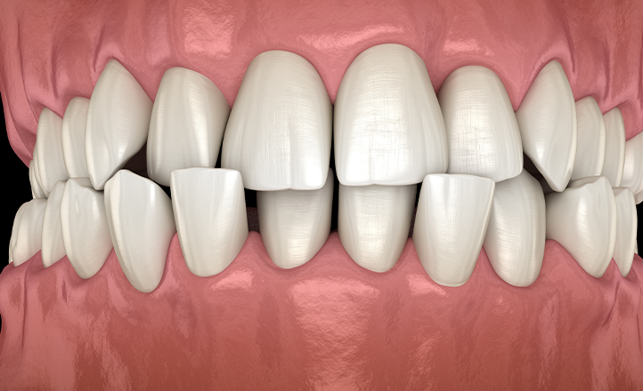 Best Crowded Teeth Treatment Condotions London UK