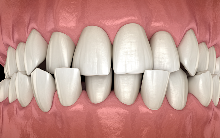 Crossbite Teeth Treatment Cost in London
