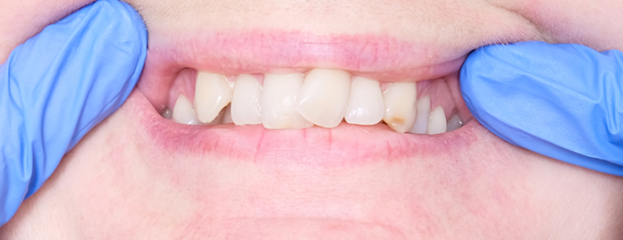 Open Bite Teeth Treatment in London