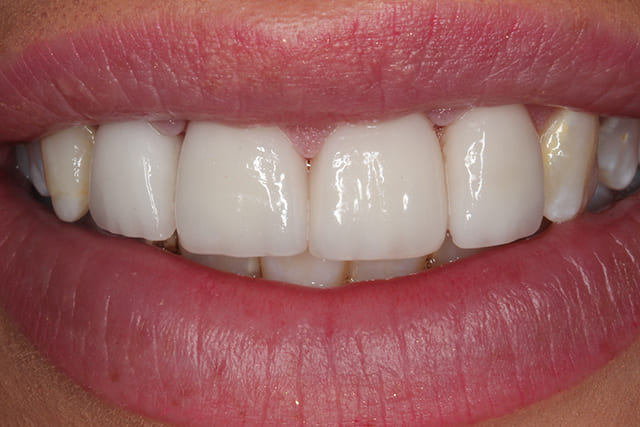 Porcelain Veneers Cost in London