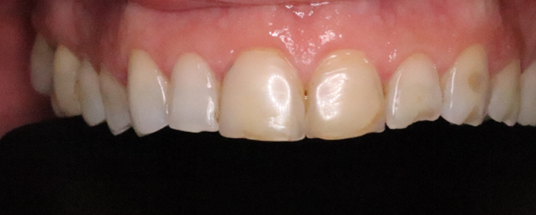 Composite Bonding Dentistry Before