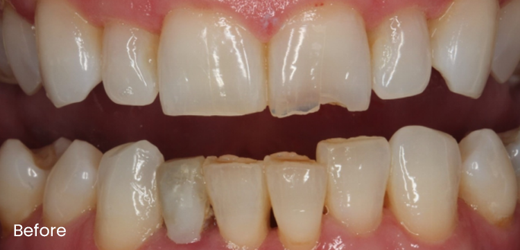 Before Composite Bonding 