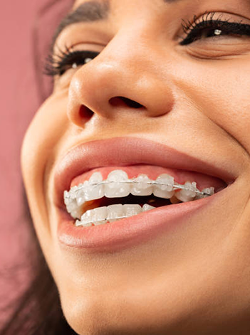 invisible ceramic fixed braces dentists