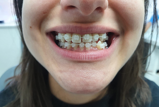 invisible orthodontic fixed braces for teeth