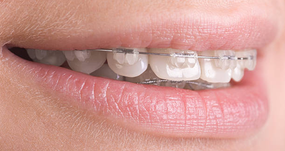 special offer packages for invisible ceramic fixed braces.webp